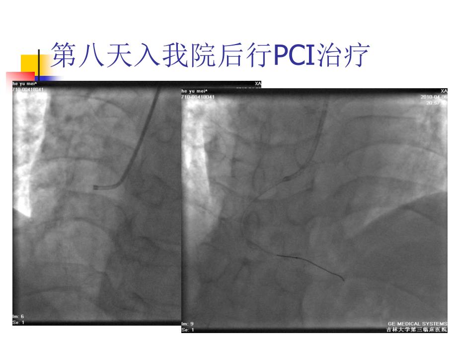 急性心肌梗死血栓抽4例_第3页