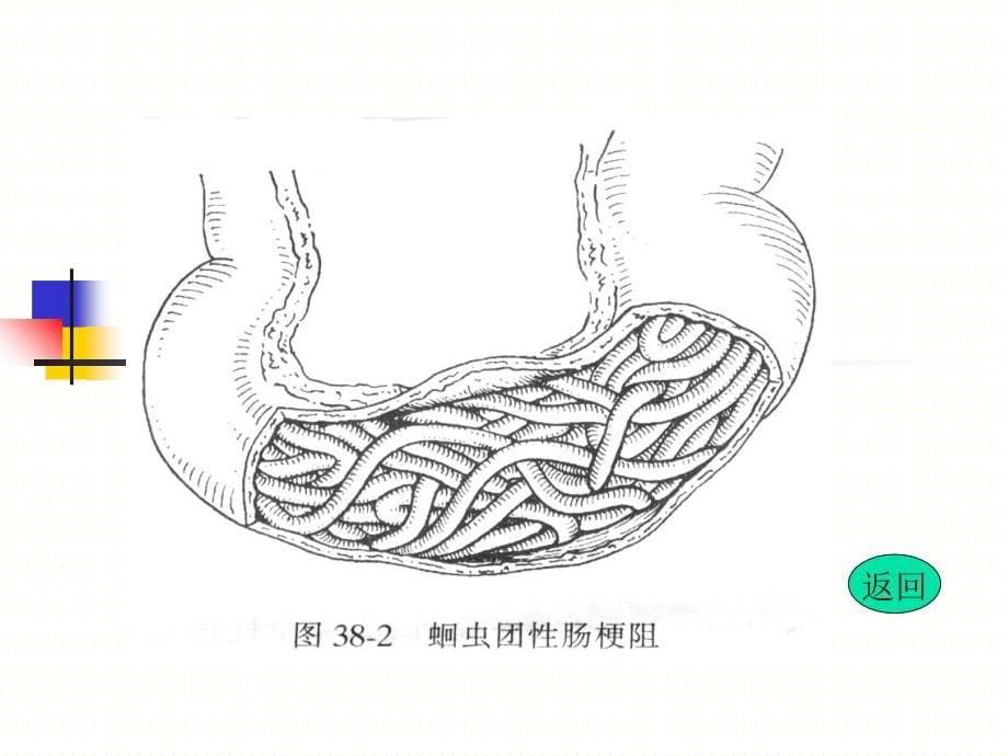 肠梗阻的病因和分类_第5页