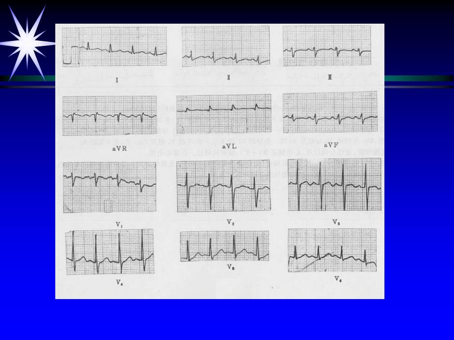 急救培训(心电图).ppt_第4页