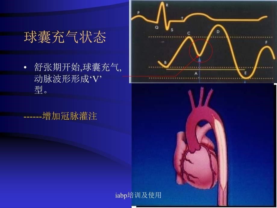 iabp培训及使用课件_第5页