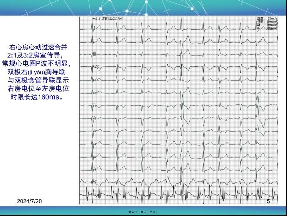 李忠杰-如何应用食管心脏电生理诊治心律失常课件_第5页