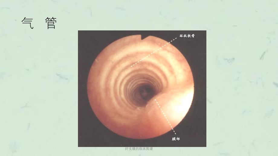 纤支镜的临床图谱课件_第4页