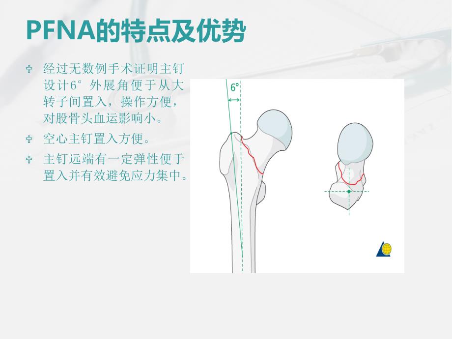 PFNA闭合复位内固定术.ppt_第4页