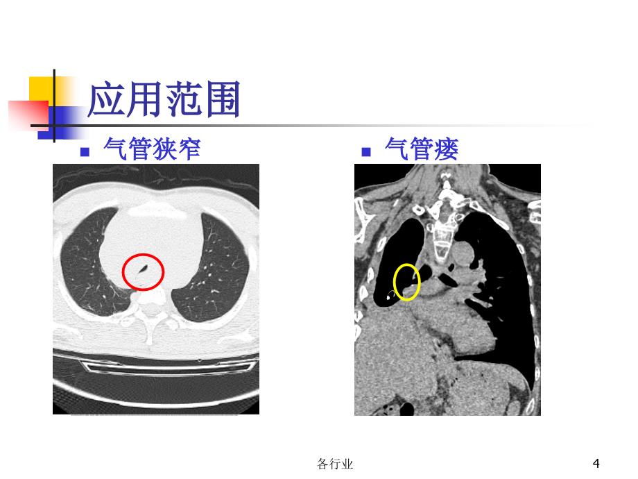 经支气管镜气管支气管支架植入【医疗研究】_第4页