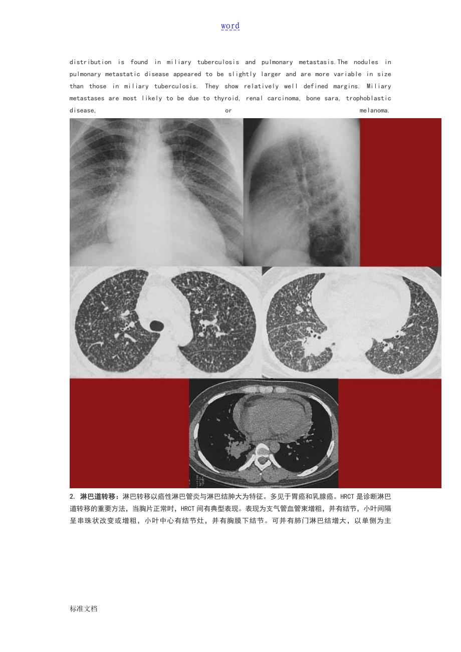 肺部转移瘤地影像诊断_第2页