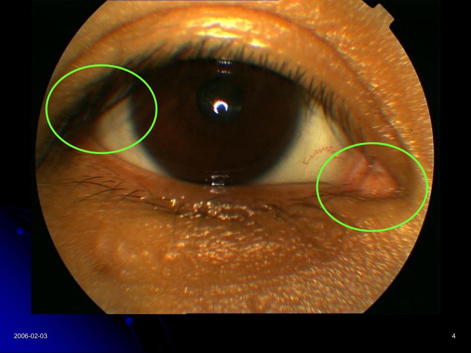 两眦疾病PPT课件_第4页