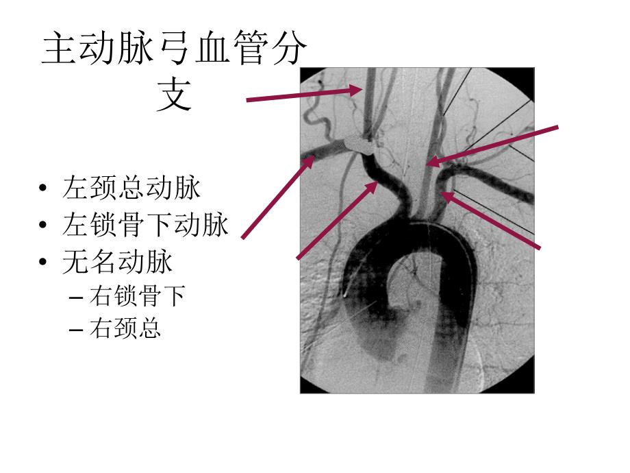 颈部血管超声正常解剖及常见病的超声诊断标准_第4页