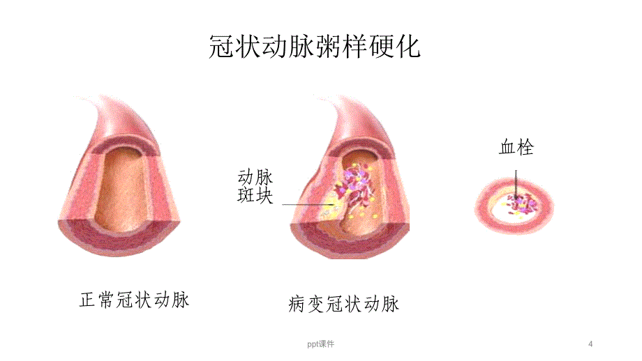 冠心病的护理查房--课件_第4页