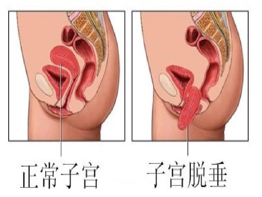 子宫脱垂PPT课件_第5页