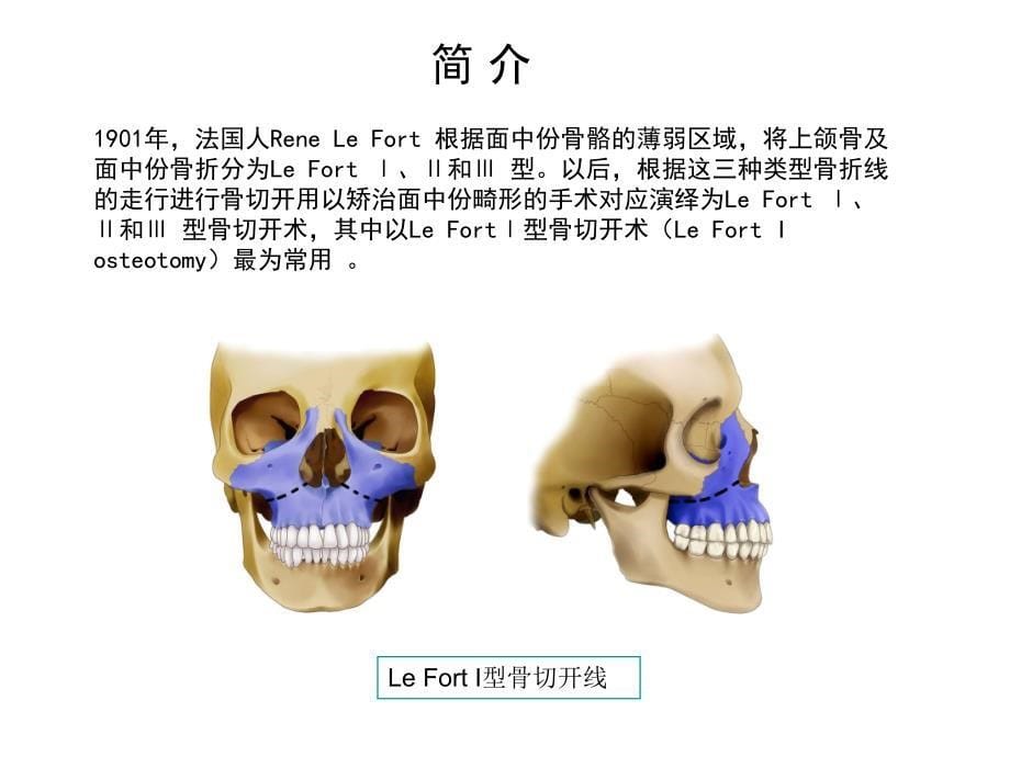 口腔颌面外科学：常用正颌外科手术_第5页