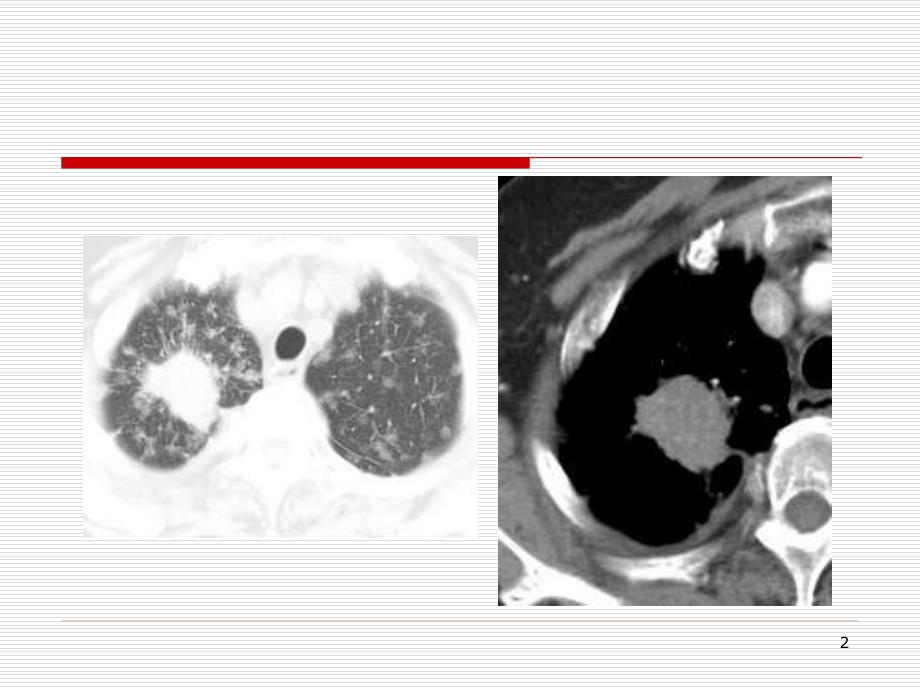 医学PPT课件早期肺腺癌诊断进展及特殊类型的肺癌影像诊断_第2页