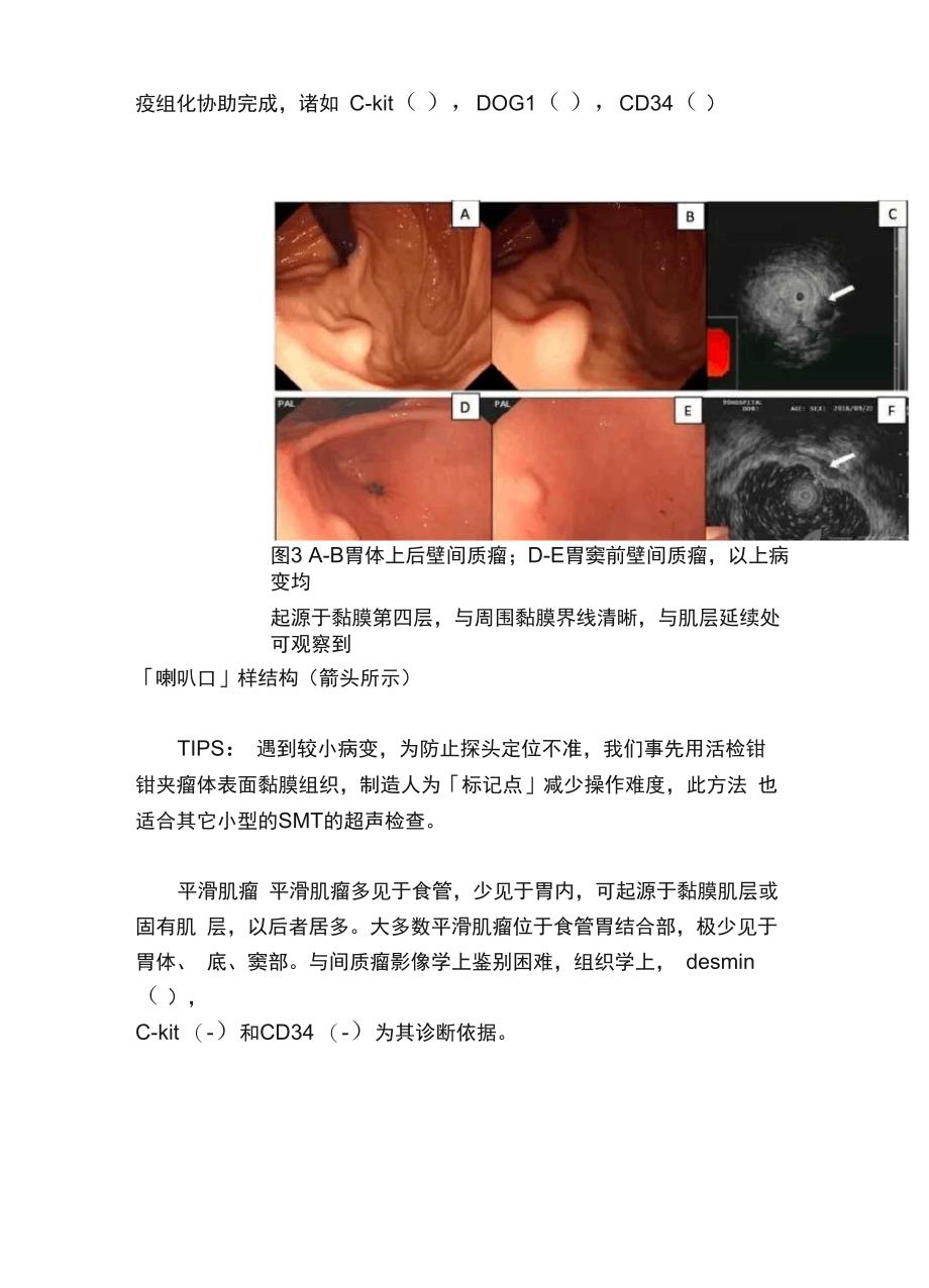 掌握这9种超声内镜表现轻松识别胃黏膜下肿瘤_第3页