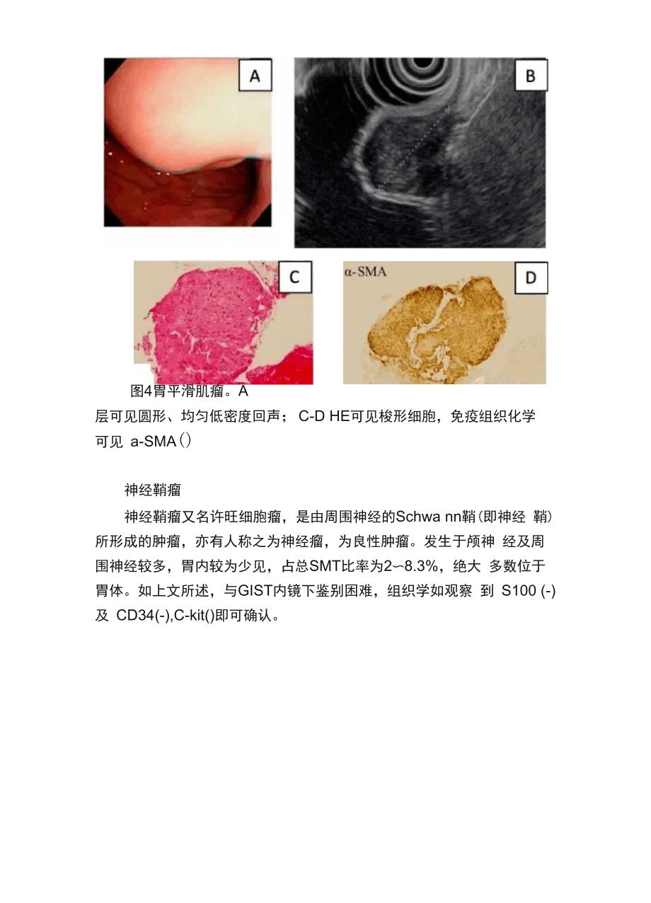 掌握这9种超声内镜表现轻松识别胃黏膜下肿瘤_第4页