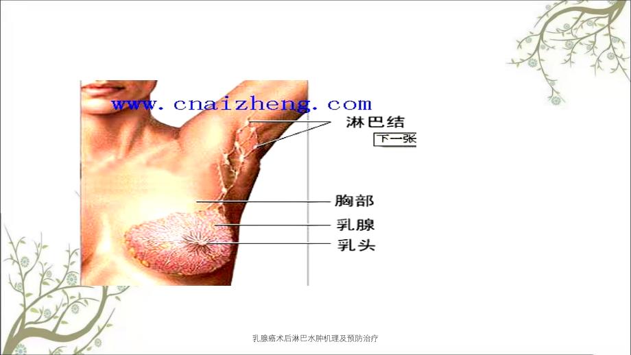 乳腺癌术后淋巴水肿机理及预防治疗_第3页