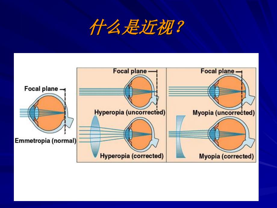 儿童近视与中医体质成都中医药大学眼科_第4页