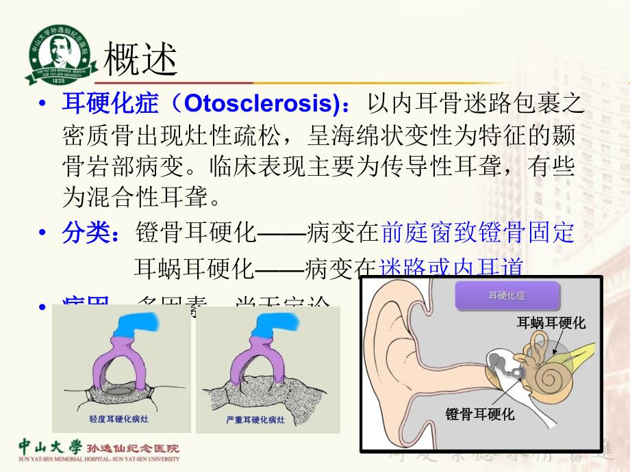 《耳鼻咽喉-头颈外科学》教学课件：4-耳硬化症_第2页