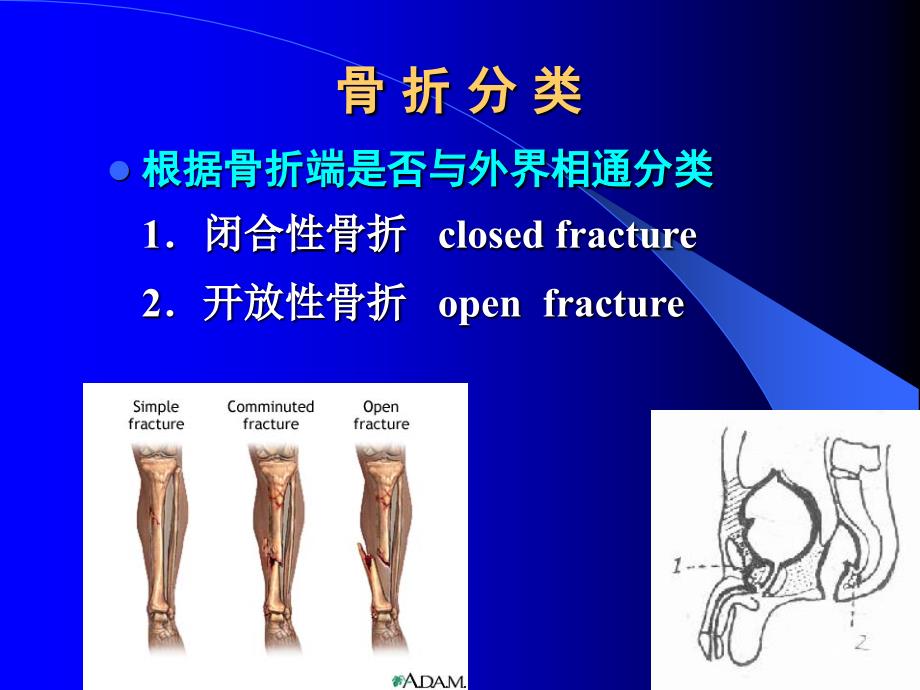 《骨折病人的护理》PPT课件_第4页