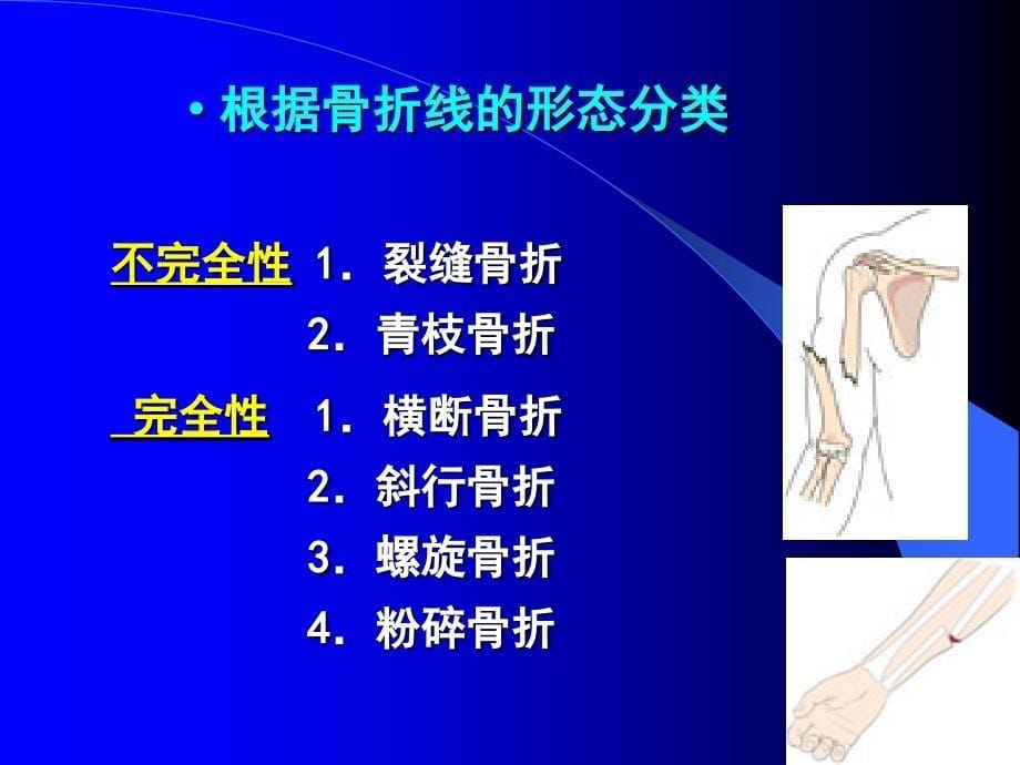 《骨折病人的护理》PPT课件_第5页