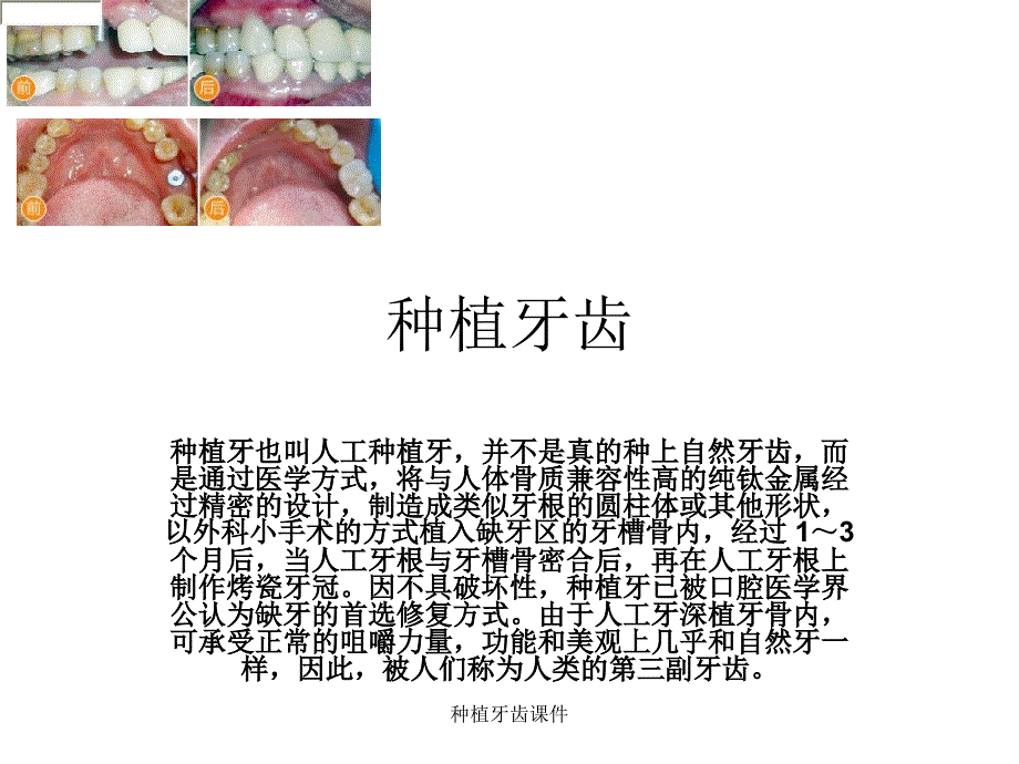 种植牙齿课件_第1页