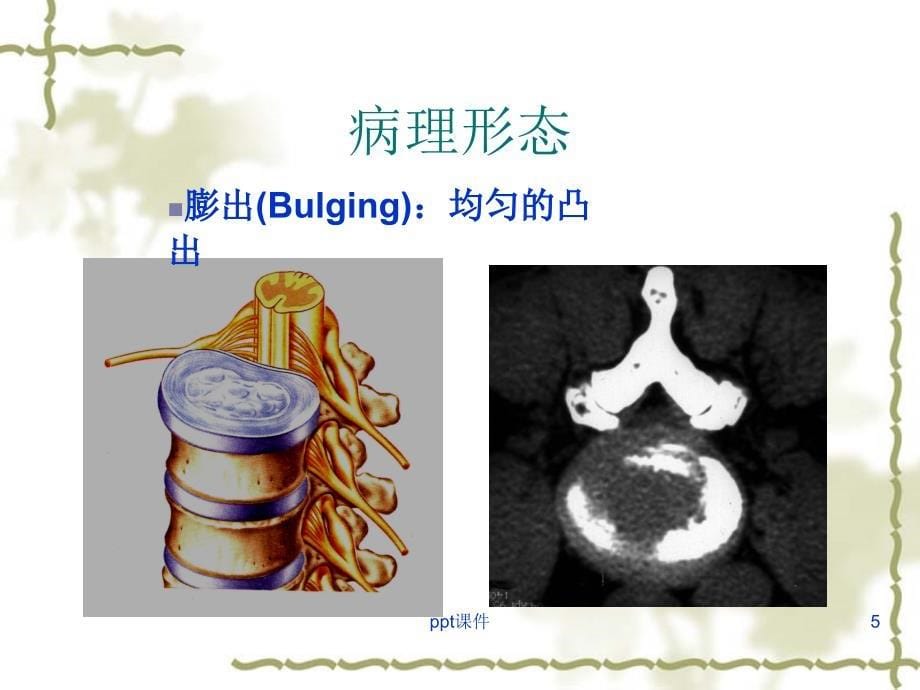 腰椎术后并发症及护理ppt课件_第5页