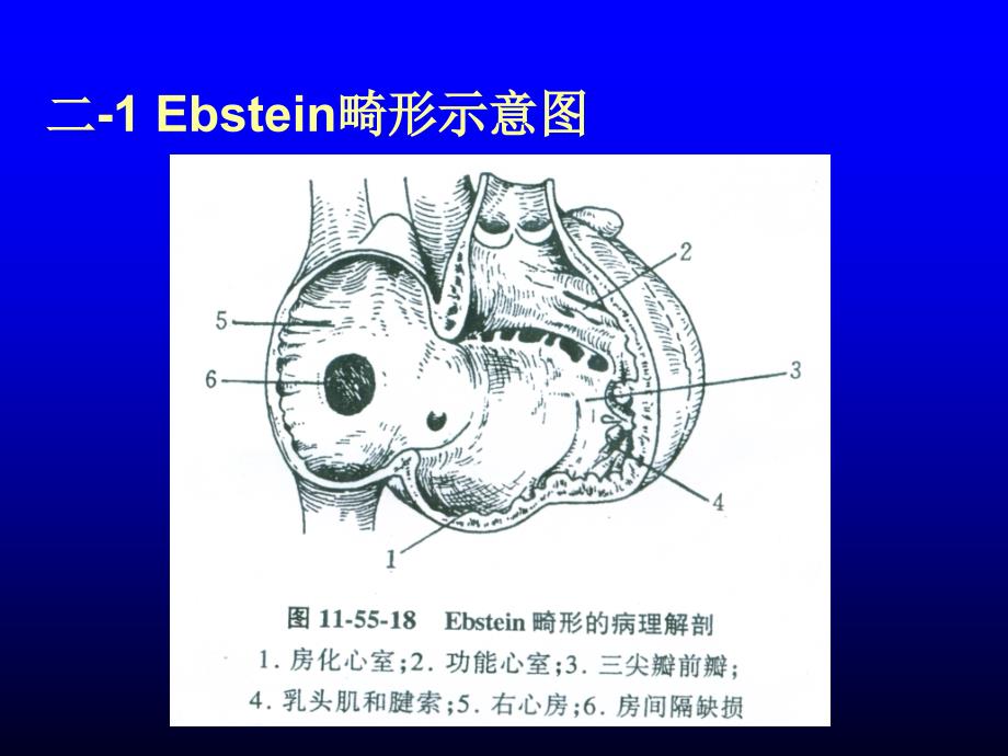 三尖瓣下移畸形-Ebstein-anomaly_第4页