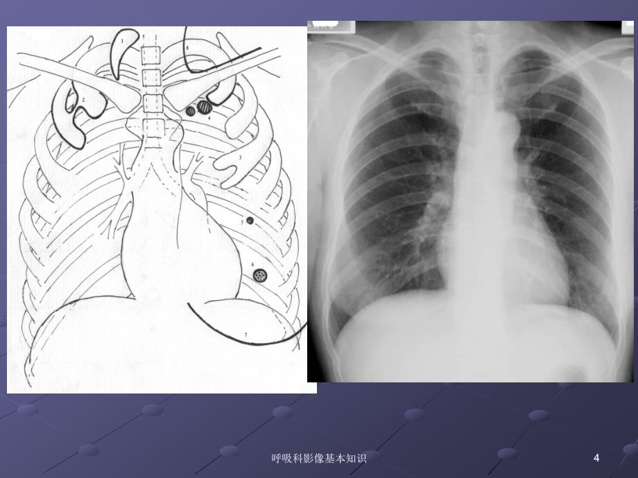 呼吸科影像基本知识培训课件_第4页