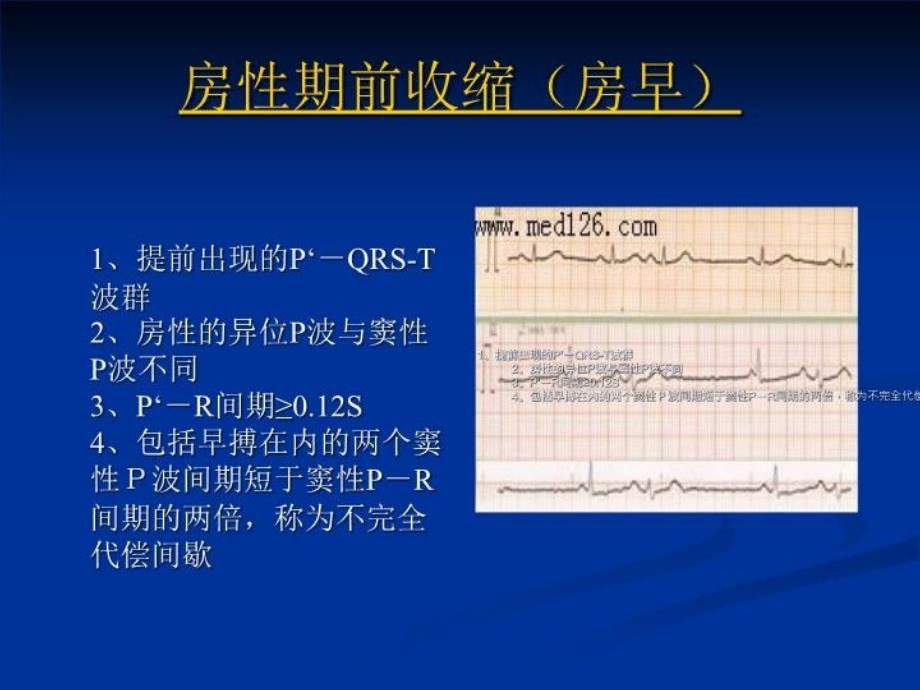 最新心电图表现PPT课件_第4页