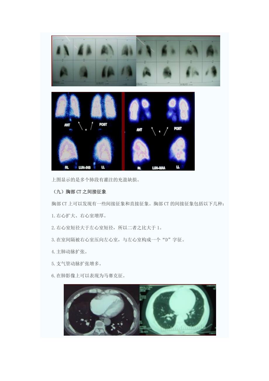 慢性血栓栓塞性肺动脉高压外科治疗_第4页