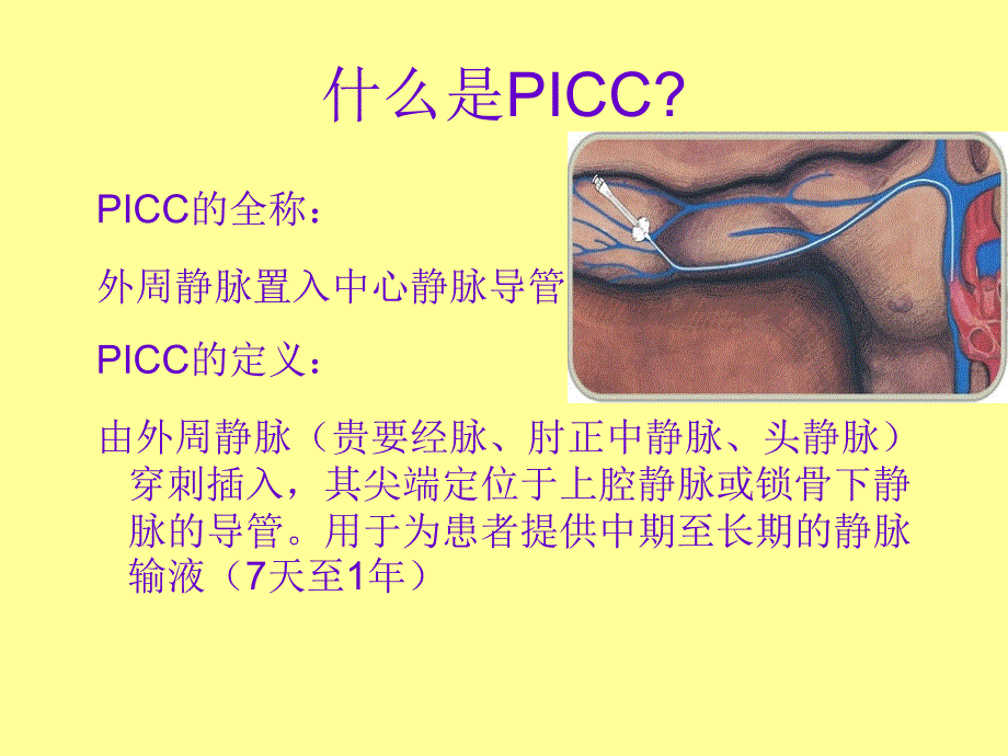 PICC置管术相关知识_第2页