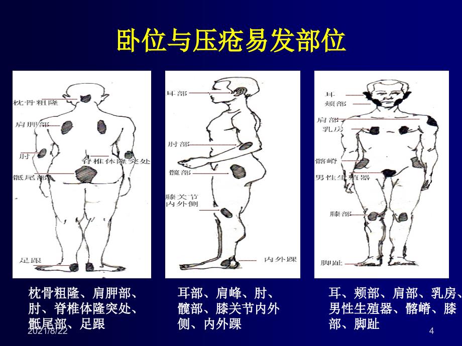 压疮预防与翻身法推荐课件_第4页