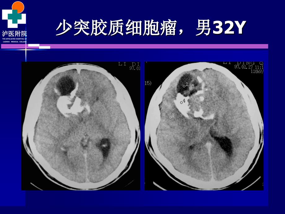 颅脑肿瘤的CT诊断_第3页