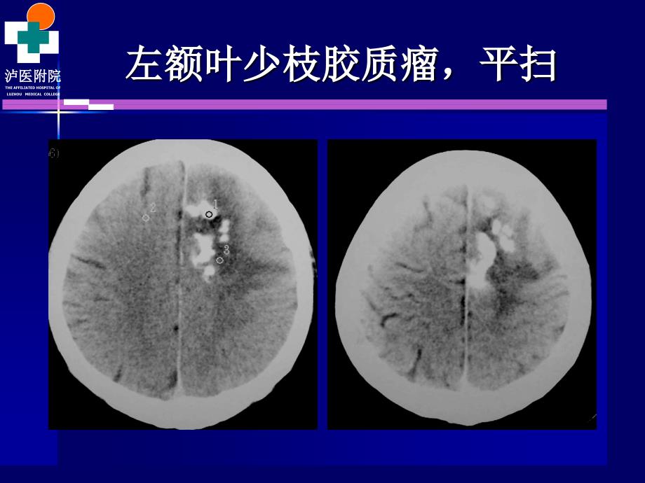 颅脑肿瘤的CT诊断_第4页