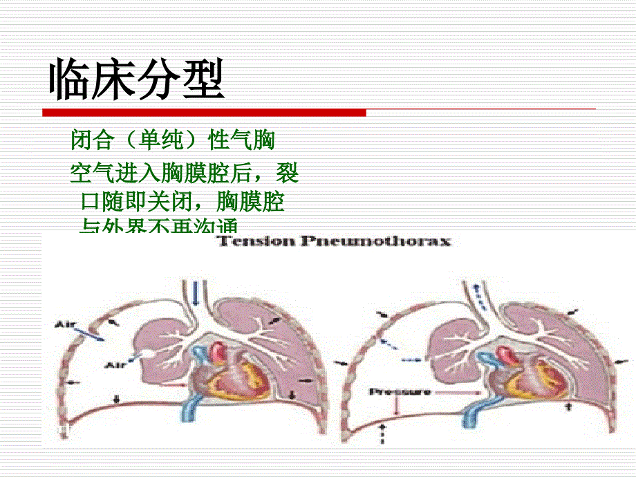 液气胸病人护理查房_第4页