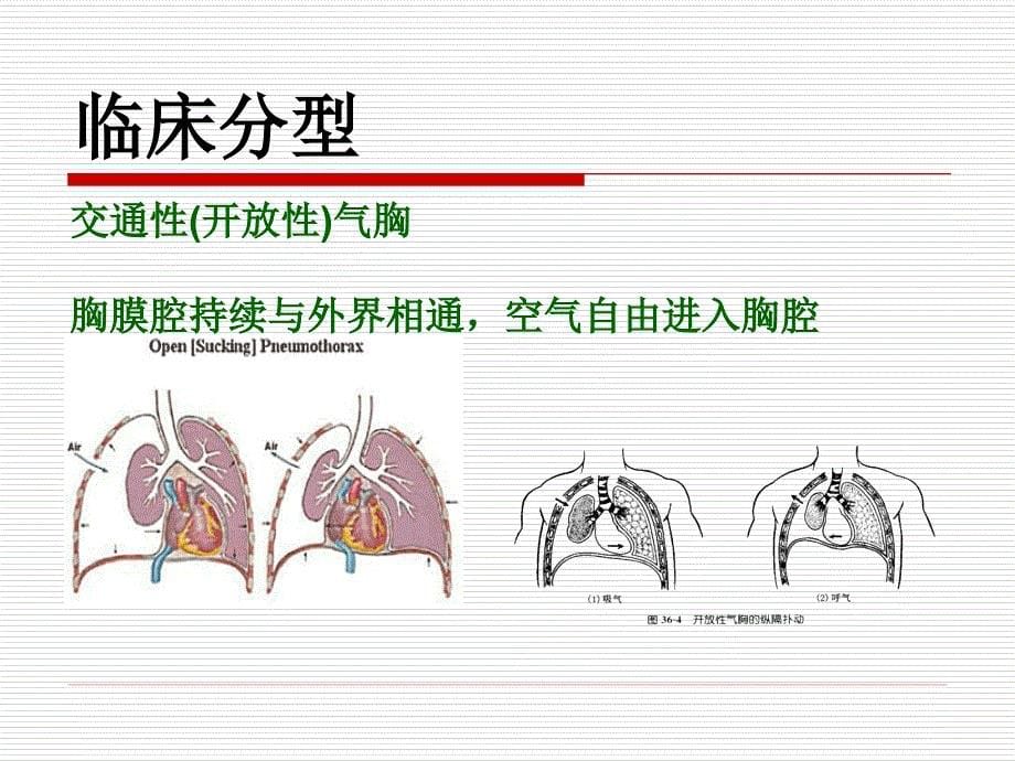 液气胸病人护理查房_第5页