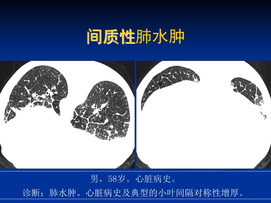 不同类型肺水肿的CT表现_第3页