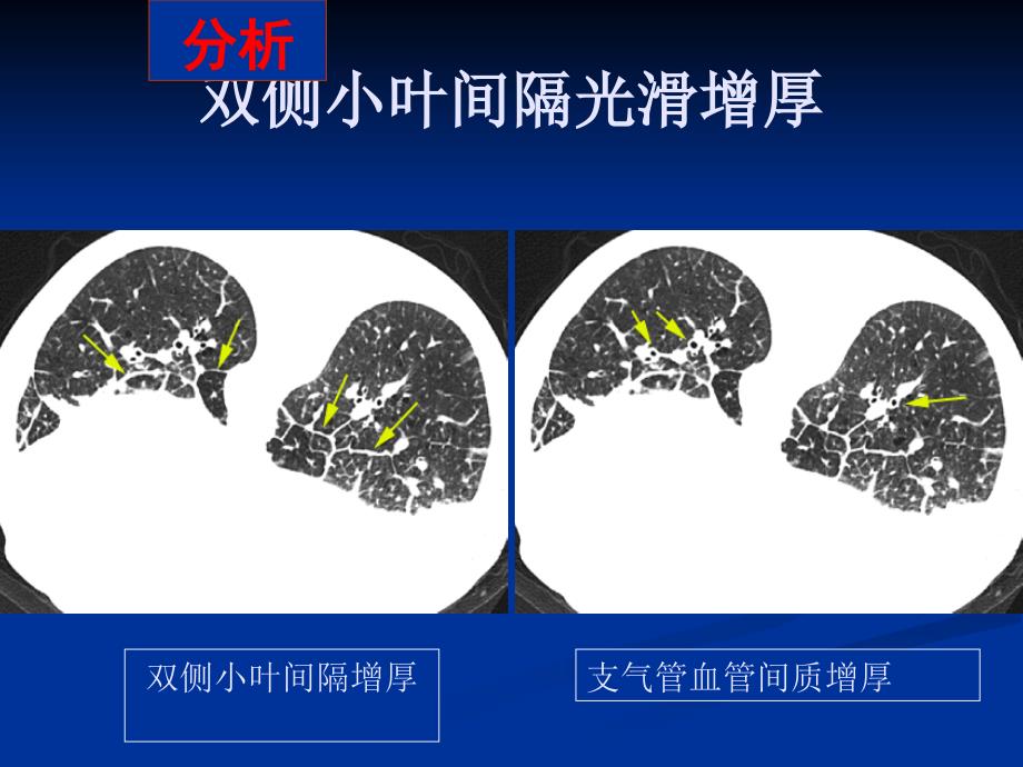 不同类型肺水肿的CT表现_第4页