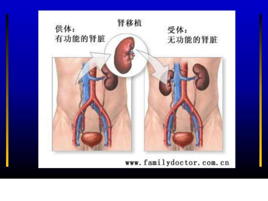 罕见器官移植手术的麻醉.ppt_第4页