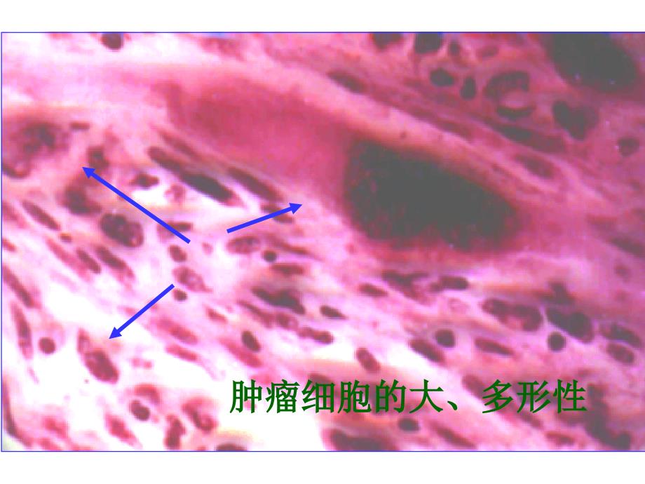 肿瘤细胞的异型性_第2页