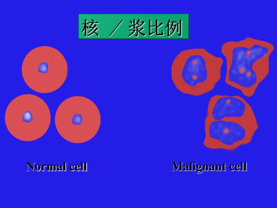 肿瘤细胞的异型性_第4页