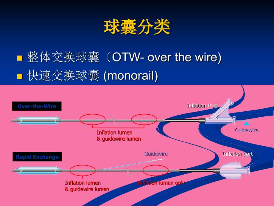 冠状动脉介入治疗球囊的选择ppt课件_第2页