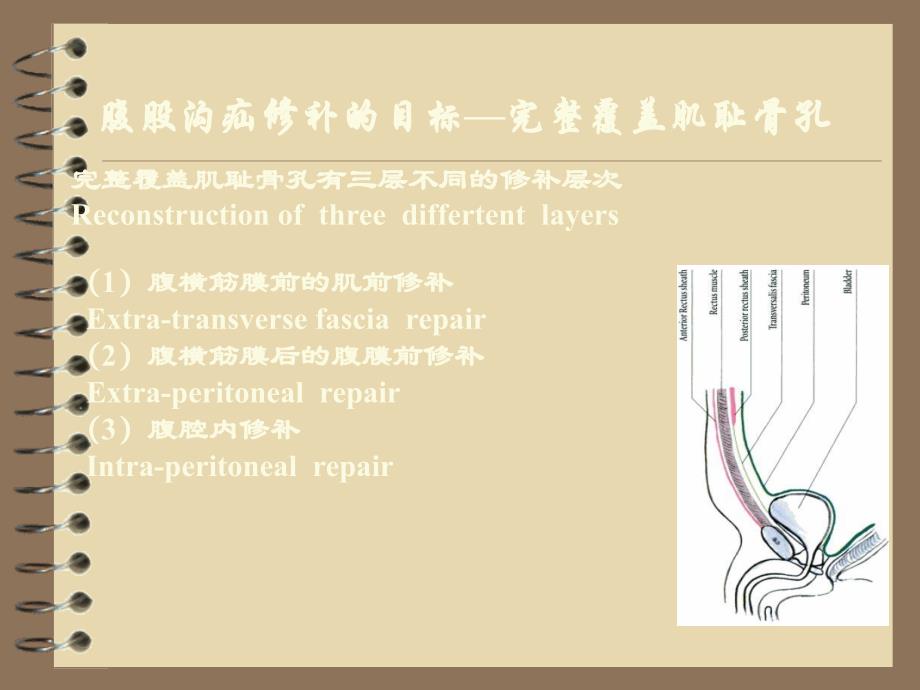 腹腔镜腹股沟疝修补术_第4页