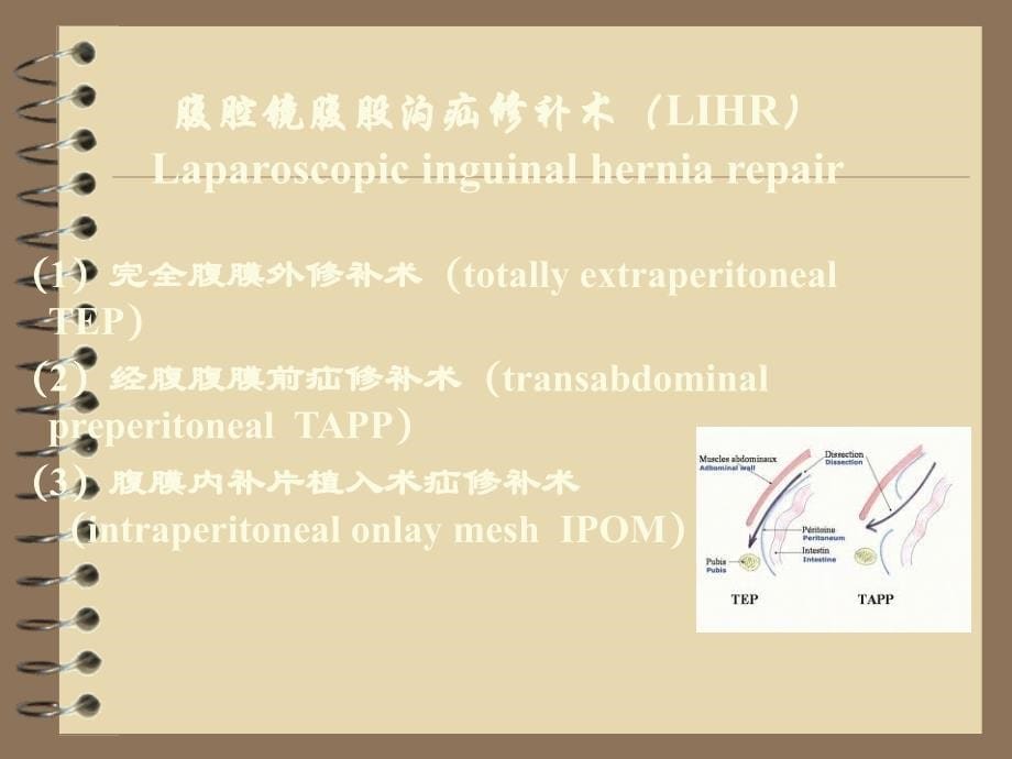 腹腔镜腹股沟疝修补术_第5页