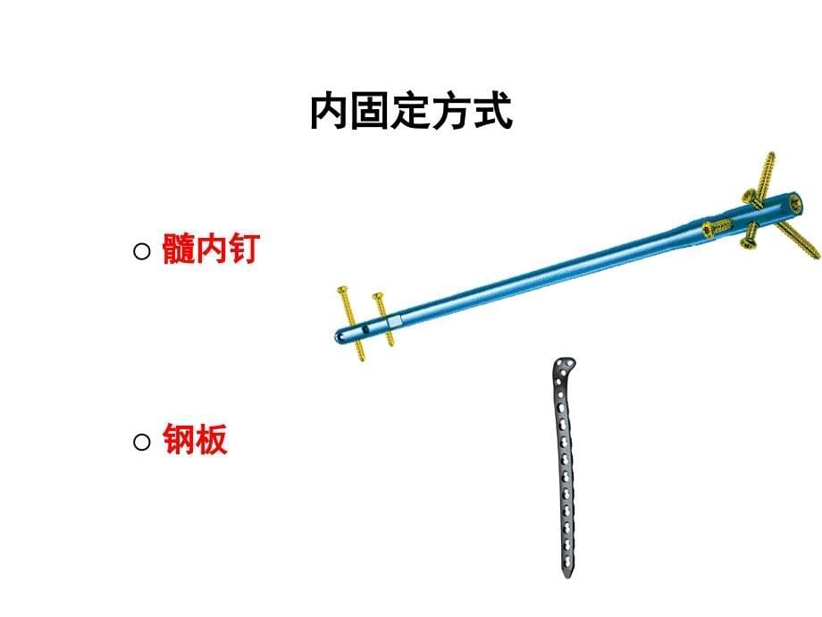 微创骨折内固定完整版课件_第5页