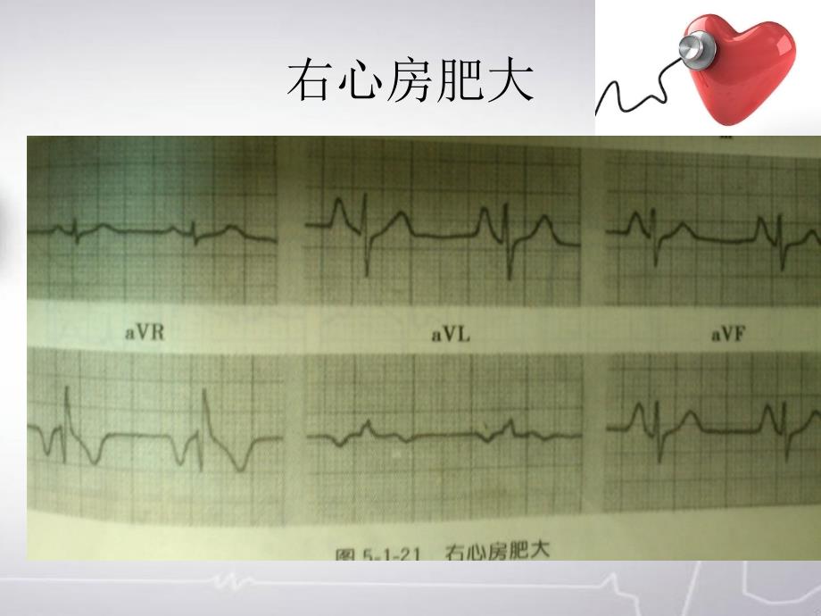 《诊断学基础》课件-异常心电图复习2_第4页