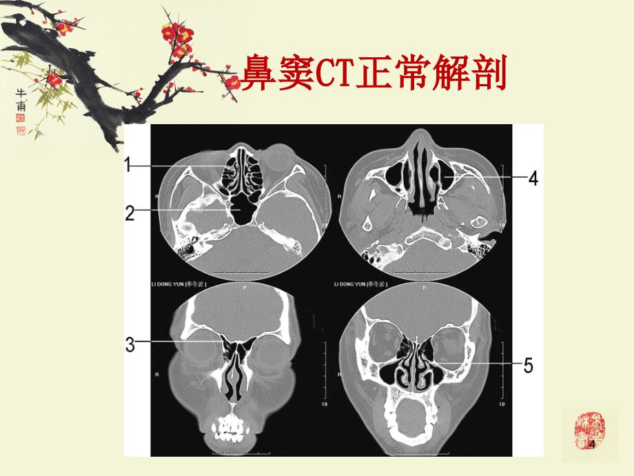 鼻与鼻窦炎的表现ppt演示课件_第4页