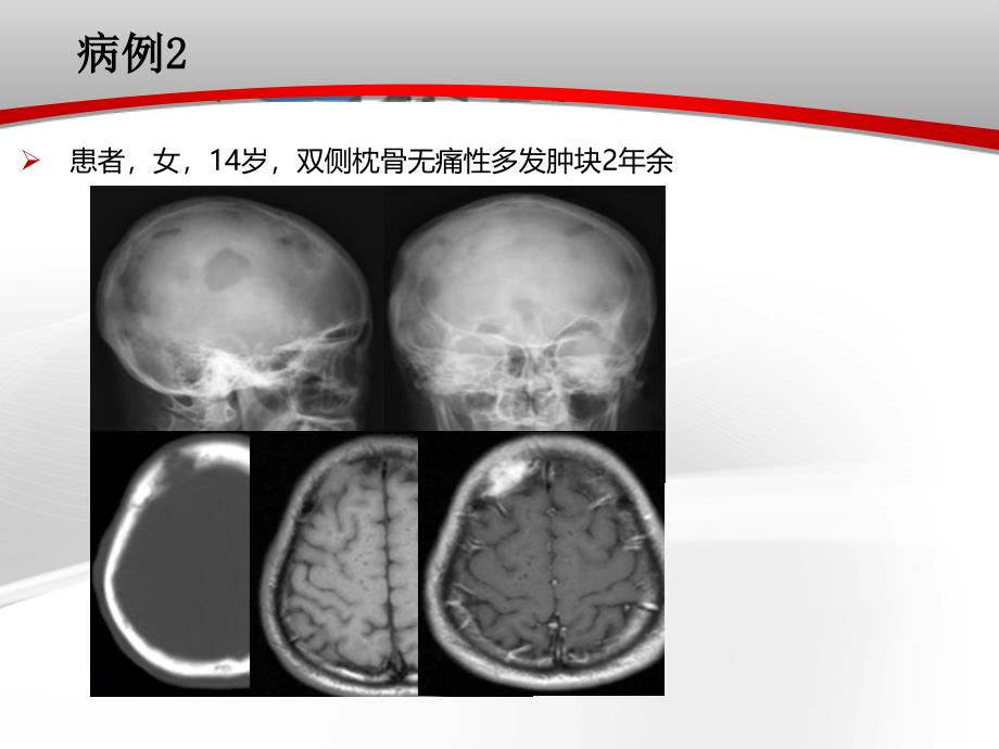 颅骨肿瘤影像学表现_第3页