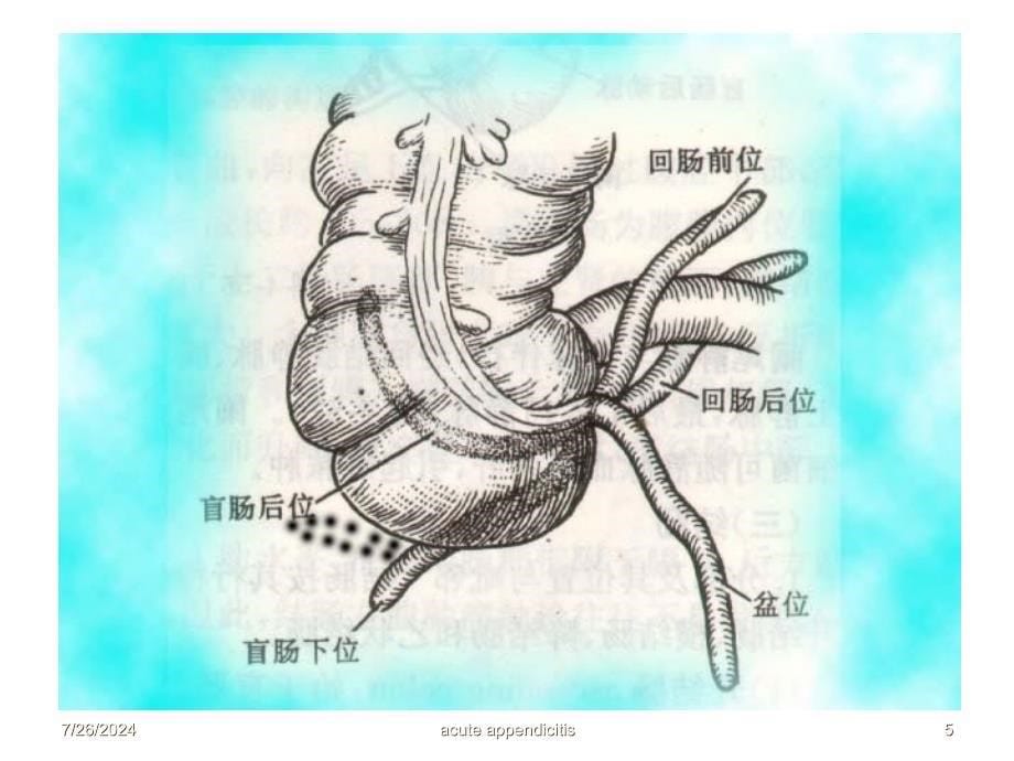 6阑尾炎大专136_第5页