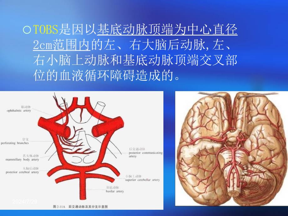 基底动脉尖综合征.课件_第3页