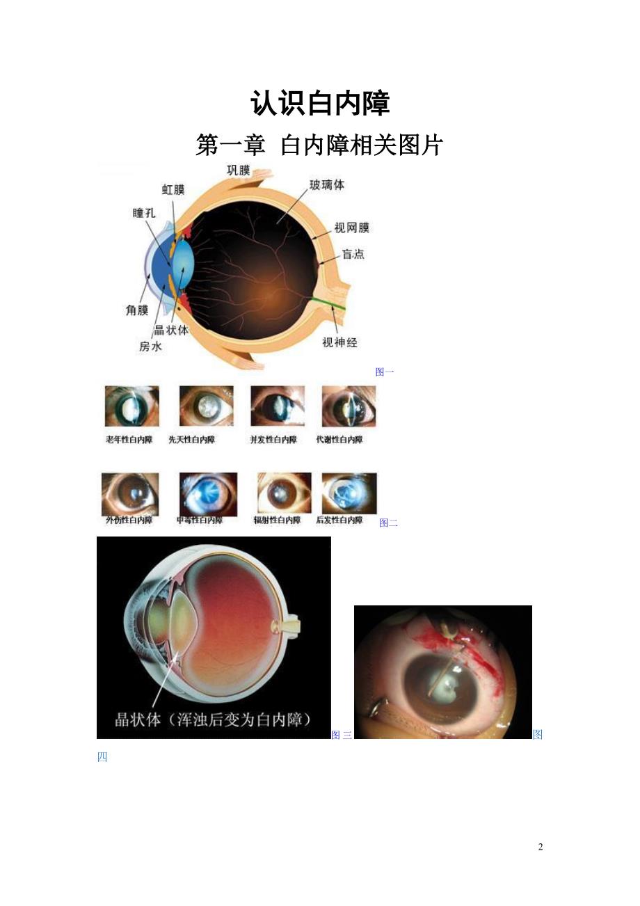 认识白内障(精品)_第2页