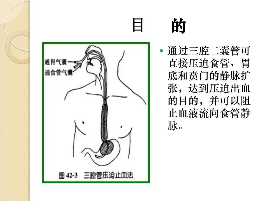 三腔二囊管的安置与护理资料课件_第3页